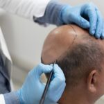 man going through follicular unit extraction process 2