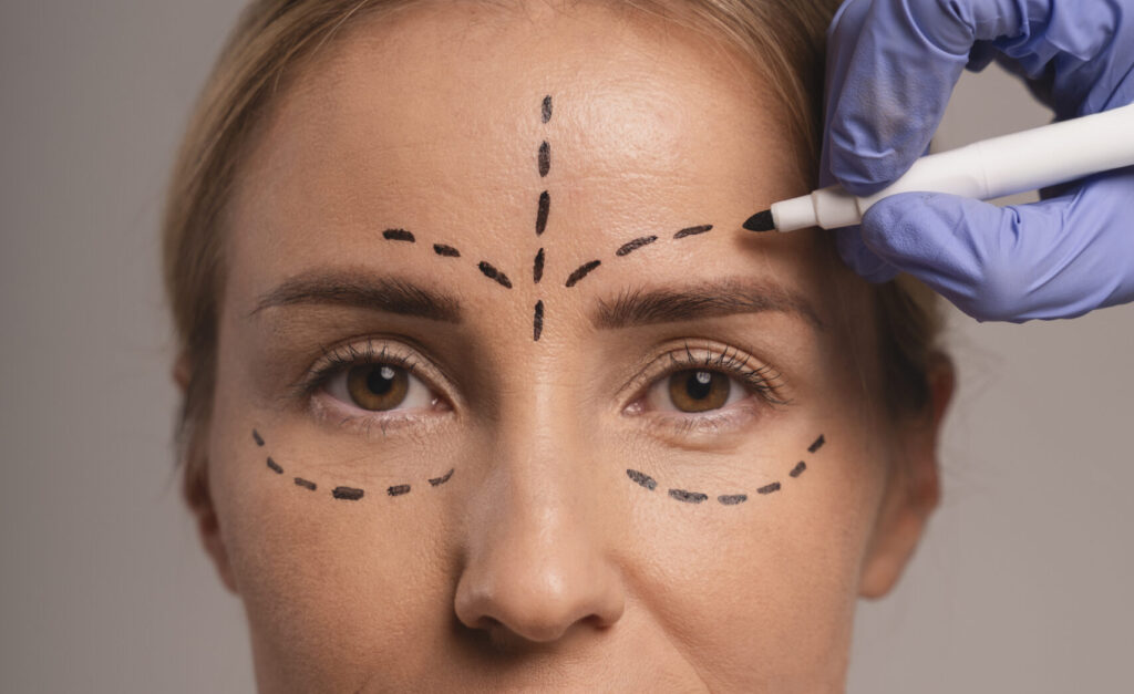Eye bag treatment at Dr. Ujjwala's Skin Clinic - Say Goodbye to Puffiness and Dark Circles 3 Woman preparing for cosmetic surgery with surgical markings on her face and a gloved hand holding a surgical marker.